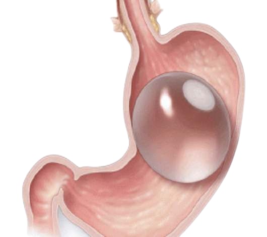 Installation or removal of gastric balloon in Tunisia