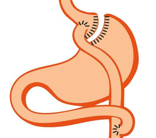 By pass in Tunisia at a low price with favorable patient reviews