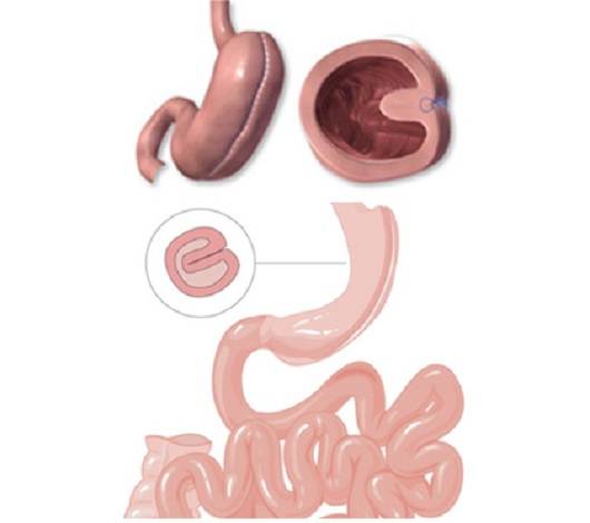 Gastric plication in Tunisia at a cheap price with favorable opinions